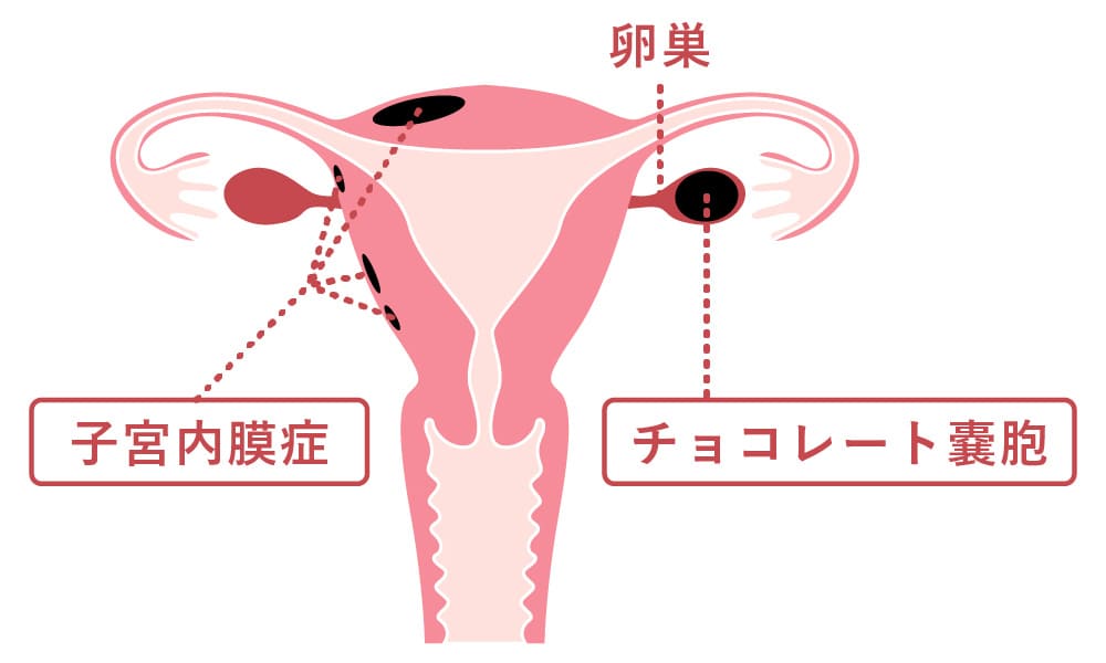 子宮内膜症／子宮腺筋症が原因の場合